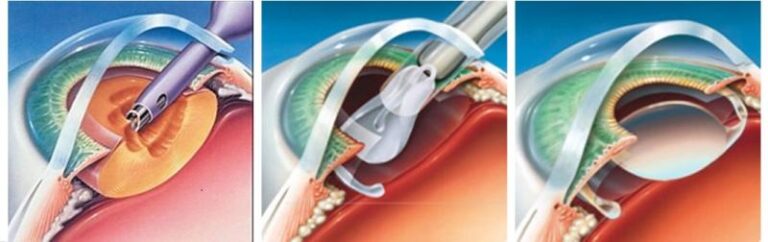 microincision-surgery-mics-who-needs-microincision-cataract-surgery