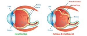 retinal detachment
